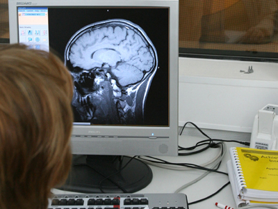 nrti,-medicamentele-anti-hiv-care-ar-putea-preveni-un-milion-de-cazuri-de-alzheimer-anual