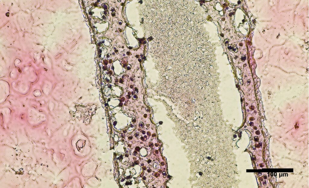 sindromul-ovarului-polichistic-ar-putea-fi-cauzat-de-lipsa-unor-bacterii-intestinale-–-studiu