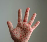 canada-isi-pierde-statutul-de-tara-fara-rujeola,-dupa-trei-decenii