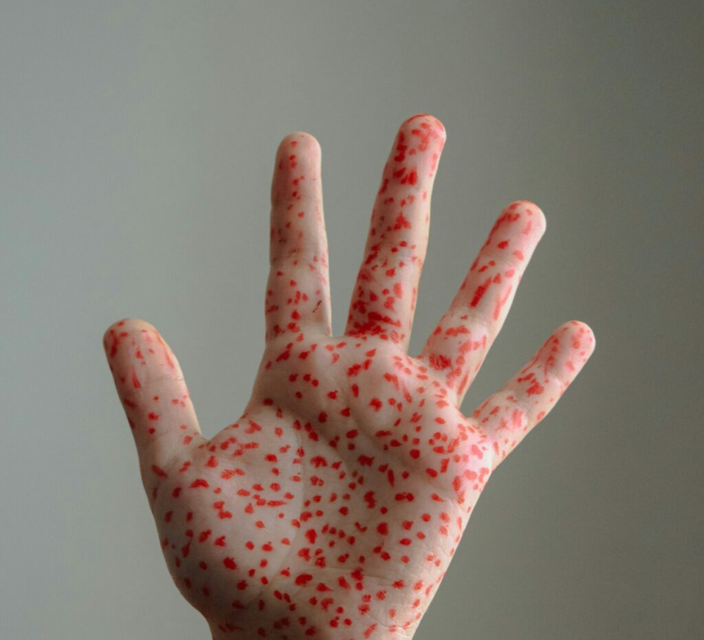 canada-isi-pierde-statutul-de-tara-fara-rujeola,-dupa-trei-decenii