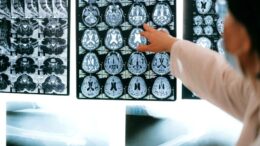 un-mecanism-ascuns-al-creierului-ar-putea-incetini-evolutia-bolii-alzheimer