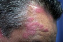 speranta-pentru-cei-care-sufera-de-psoriazis:-o-noua-tehnica-fotonica-reuseste-sa-il-trateze-fara-efecte-secundare