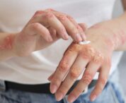 pielea-pierde-apa-iarna:-sfaturile-medicilor-pentru-protectie