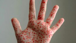 epidemia-de-rujeola-din-sua,-scapata-de-sub-control:-copiii-mor-din-cauza-unei-boli-care-poate-fi-prevenita”