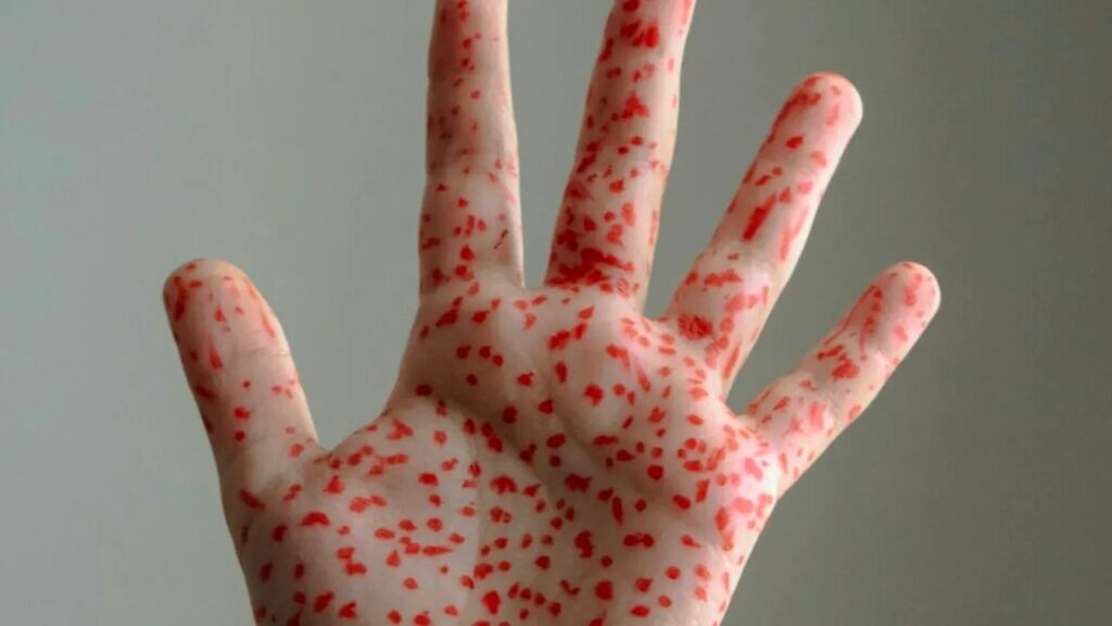 epidemia-de-rujeola-din-sua,-scapata-de-sub-control:-copiii-mor-din-cauza-unei-boli-care-poate-fi-prevenita”