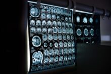 o-femeie-s-a-dus-la-medic-sustinand-ca-aude-voci-care-ii-spun-ca-are-o-tumoare-cerebrala.-chiar-avea