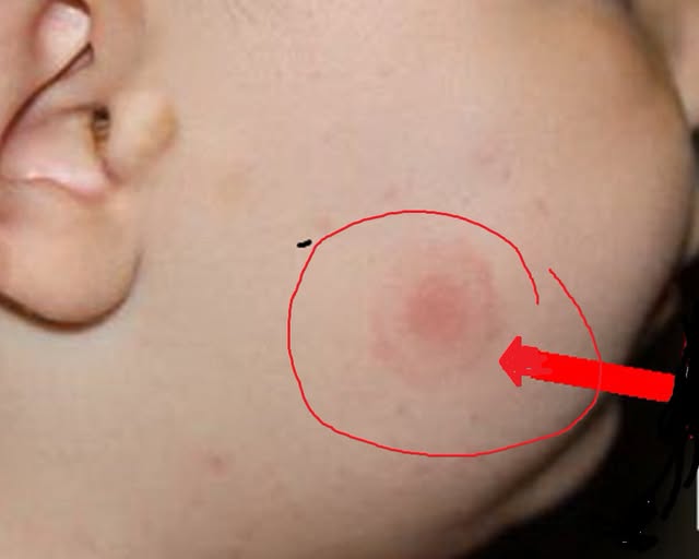 doctorul-tudor-ciuhodaru:-ce-trebuie-sa-stiti-(sa-faceti)-in-cazul-muscaturilor-de-capuse