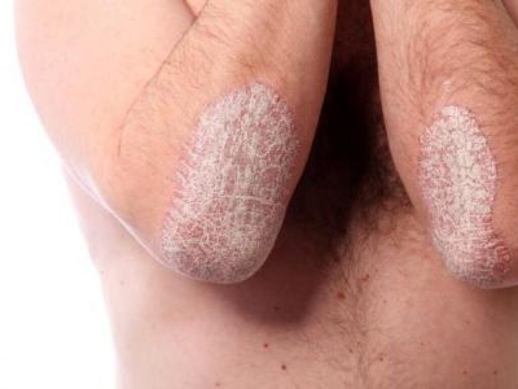 o-simpla-pilula-ar-putea-sa-vindece-si-cel-mai-urat-psoriazis-/-tratament-oral-inovator-–-asteapta-sa-fie-autorizat-in-ue
