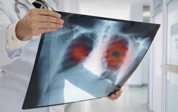 tusea-care-persista-mai-mult-de-trei-saptamani-poate-ascunde-un-cancer-pulmonar