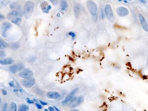 cancerul-care-poate-fi-prevenit.-ce-spune-un-studiu-nou-despre-infectii